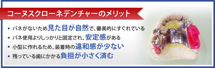 コーヌスクローネデンチャーのメリット